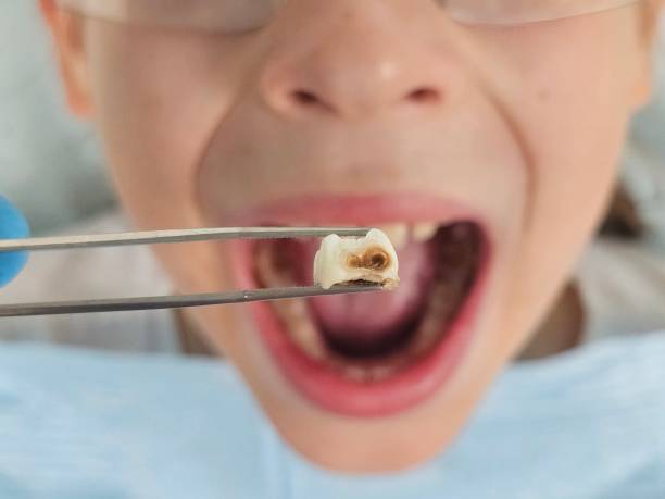 Best Emergency Broken Tooth Repair in Teutopolis, IL